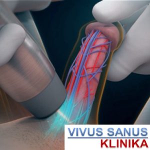 Erekcijos sutrikimų gydymas